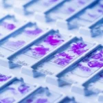 AI can detect cancer but shows bias across demographics. FAIR-Path framework reduces disparities, enabling fairer pathology AI diagnoses.