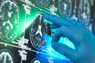 Alzheimer’s Drugs May Offer Limited Patient Benefit, New Analysis Finds High Cost and Limited Access Raise Questions A new independent analysis has found that so called breakthrough Alzheimer’s drugs are unlikely to deliver meaningful benefits for most patients. Researchers say the impact remains far below what is needed to improve daily life for people living with dementia. These drugs are approved in several countries. However, they are not funded by the NHS in the UK. Private treatment can cost around £90,000 for an 18 month course, making them unaffordable for most patients. How the Drugs Work The treatment targets a sticky substance called beta amyloid. This protein builds up between brain cells in Alzheimer’s disease and is linked to memory loss and cognitive decline. Scientists designed antibodies to identify and remove this protein from the brain. These antibodies work in a similar way to natural immune defenses that fight infections. Mixed Results From Clinical Trials Early attempts to remove amyloid failed to show results. More recent trials involving donanemab and lecanemab showed a small slowing of cognitive decline. Researchers described this as an important scientific step. It was the first time any treatment had shown an ability to slow brain deterioration in Alzheimer’s disease. Large Review Finds Limited Benefit The Cochrane Collaboration reviewed data from 17 studies involving more than 20,000 participants. The review found that amyloid removing drugs do slow the disease. However, the improvement was too small to make a noticeable difference in patients’ everyday lives. Safety Risks and Treatment Burden The drugs are also linked to serious side effects. Some patients experienced brain swelling and bleeding during treatment. In addition, the therapy requires regular infusions every two to four weeks. This creates a long term treatment burden for patients and healthcare systems. Scientific Debate Continues The findings have triggered disagreement among scientists. Some researchers believe the drugs represent real progress in treating Alzheimer’s disease. Others argue the clinical benefits are too small to justify widespread use.