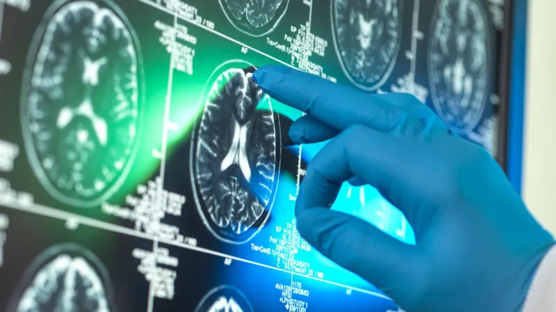 Alzheimer’s Drugs May Offer Limited Patient Benefit, New Analysis Finds High Cost and Limited Access Raise Questions A new independent analysis has found that so called breakthrough Alzheimer’s drugs are unlikely to deliver meaningful benefits for most patients. Researchers say the impact remains far below what is needed to improve daily life for people living with dementia. These drugs are approved in several countries. However, they are not funded by the NHS in the UK. Private treatment can cost around £90,000 for an 18 month course, making them unaffordable for most patients. How the Drugs Work The treatment targets a sticky substance called beta amyloid. This protein builds up between brain cells in Alzheimer’s disease and is linked to memory loss and cognitive decline. Scientists designed antibodies to identify and remove this protein from the brain. These antibodies work in a similar way to natural immune defenses that fight infections. Mixed Results From Clinical Trials Early attempts to remove amyloid failed to show results. More recent trials involving donanemab and lecanemab showed a small slowing of cognitive decline. Researchers described this as an important scientific step. It was the first time any treatment had shown an ability to slow brain deterioration in Alzheimer’s disease. Large Review Finds Limited Benefit The Cochrane Collaboration reviewed data from 17 studies involving more than 20,000 participants. The review found that amyloid removing drugs do slow the disease. However, the improvement was too small to make a noticeable difference in patients’ everyday lives. Safety Risks and Treatment Burden The drugs are also linked to serious side effects. Some patients experienced brain swelling and bleeding during treatment. In addition, the therapy requires regular infusions every two to four weeks. This creates a long term treatment burden for patients and healthcare systems. Scientific Debate Continues The findings have triggered disagreement among scientists. Some researchers believe the drugs represent real progress in treating Alzheimer’s disease. Others argue the clinical benefits are too small to justify widespread use.