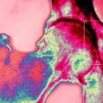 AI Designed Bone Like Materials Could Make Hip Implants Last Longer