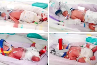 Rare Identical Quadruplets Born in Australia After High Risk Pregnancy A Rare Birth Surprises Australian Family An Australian family has welcomed four identical baby girls after an incredibly rare pregnancy that doctors describe as one of the rarest natural pregnancies ever recorded. The babies were born by caesarean section at 28 weeks and four days after doctors closely monitored the mother's condition throughout the pregnancy. Jenitar Na'amoana, 34, and her husband Jortham already had four children. They never expected to hear they were going to have quadruplets. The unexpected news came as a huge surprise to the family. Doctors Call the Pregnancy Exceptionally Rare Medical specialists confirmed the babies are naturally conceived monozygotic quadruplets. This means one fertilised egg divided into four separate embryos. Doctors estimate this type of pregnancy happens in only one out of every 15 million pregnancies. The medical team also explained that all four babies shared a single placenta. Specialists say this makes the pregnancy even more unusual and extremely rare. Careful Monitoring Helped Protect Mother and Babies Because of the high risks, doctors admitted Jenitar to the hospital at 25 weeks so they could closely monitor both her and the babies. Their main goal was to safely reach at least 28 weeks of pregnancy. The medical team successfully managed the pregnancy, and the babies arrived at 28 weeks and four days. Although they were born prematurely, doctors reported that all four girls are healthy and receiving the care they need. Family Celebrates a Remarkable Milestone Doctors described the successful birth as an incredible achievement. Reaching more than 28 weeks with such a rare pregnancy gave the babies a stronger start than many specialists expected. The family is now celebrating the arrival of four healthy daughters while medical staff continue to care for the newborns during their early weeks. A Pregnancy That Will Be Remembered Naturally conceived identical quadruplets are among the rarest births in the world. Medical experts say pregnancies like this are almost never seen, making the birth of these four sisters an extraordinary event in Australia.